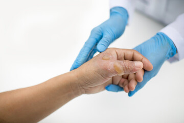 Doctor holding patient's hand and thumb with burn injuries. Nurse with gloves attending a man's...