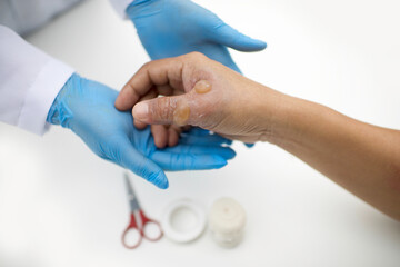 First aid treatment in patient with burn injury on hand and thumb. Doctor with gloves attending to a man's blisters.Bandage and scissor in background.Wound care in hospital.White background.