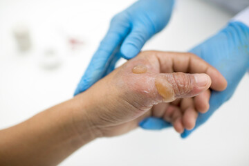 Doctor holding patient's hand and thumb with burn injuries. Nurse with gloves attending a man's...