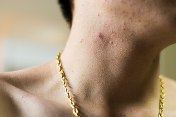 Close-up of a man wearing a gold necklace with lots of acne.
