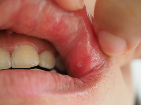 Asian woman with aphtha in the corner of her mouth above. closeup photo, blurred.