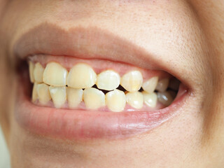 Obraz premium Yellow teeth of a woman. closeup photo, blurred.