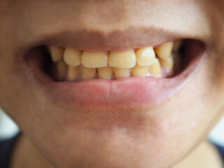 Woman smile with dirty yellow teeth. closeup photo, blurred.