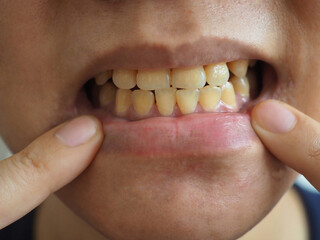 Yellow teeth problem. oral health concept. closeup photo, blurred.
