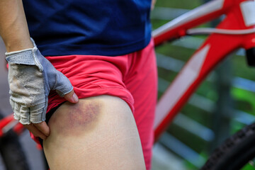 People with bruised leg casused by bike accident