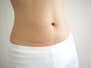 Fototapeta na wymiar Scar on woman's abdomen after appendicitis removal and abdominal surgery. closeup photo, blurred.