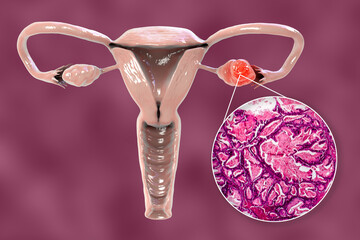 Ovarian cancer, 3D illustration - obrazy, fototapety, plakaty