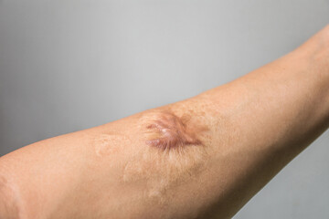 Close up Keloid scar (Hypertrophic Scar) on man arm skin after accident