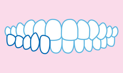 噛み合わせのイラスト © わさび