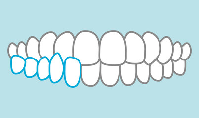 歯並びのイラスト © わさび