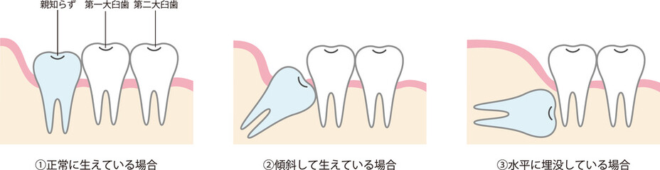親知らずのイラスト Wall Mural Wallpaper Murals わさび 親知らずのイラスト Wall Mural Wallpaper Murals わさび