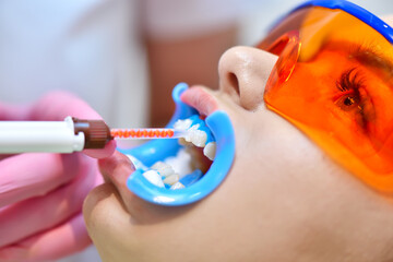 Dentist applies whitening gel to patient's teeth.