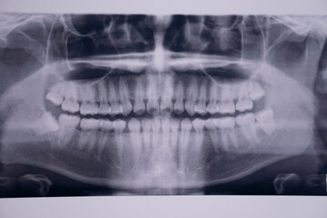 X ray dental tooth X-ray of a 17 year old teenage male teeth bones to check abnormal tooth before...