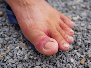 Toe inflammation isolated background. Concept of foot health care.