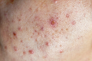 Closeup of woman face with bad skin and red acne