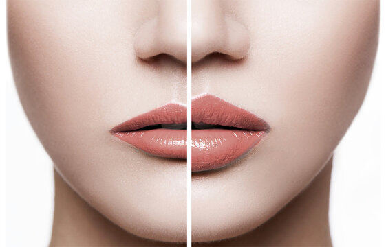Closeup of female lips before and after augmentation procedure.