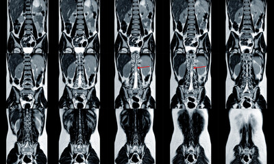 MRI spine showing mass at distal cord and conus medullaris, with tumor seedings at lower spinal...