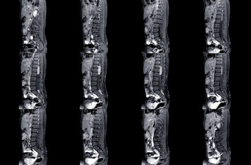 MRI spine showing mass at distal cord and conus medullaris, with tumor seedings at lower spinal canal. The mass appear hypersignal T2 and strong enhancement. DDx. Myxopapillary ependymoma - obrazy, fototapety, plakaty