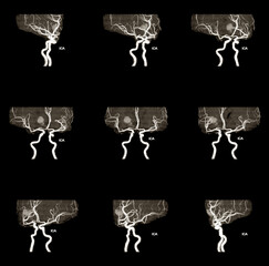 MRA AND MRV OF BRAIN History: A 61-year-old female, presented with intracranial hemorrhage.
