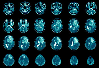 Magnetic resonance imaging Finding  5 cm isodense mass with ill-defined margin and surrounding edema at Left frontal lobe. Glioblastoma, brain metastasis.science and education mri brain background. - obrazy, fototapety, plakaty