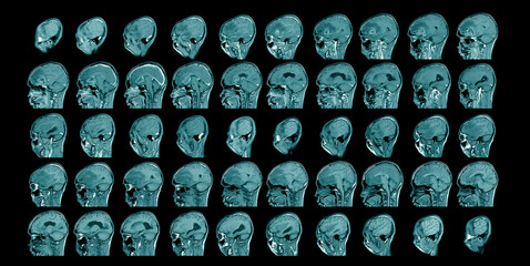 Magnetic resonance imaging Finding  5 cm isodense mass with ill-defined margin and surrounding edema at Left frontal lobe. Glioblastoma, brain metastasis.science and education mri brain background.