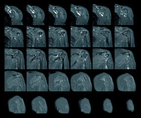 Magnetic resonance imaging of left shoulder rotator cuff tear with suspected lipoma of left...