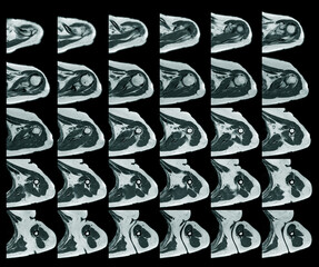 Magnetic resonance imaging of left shoulder rotator cuff tear with suspected lipoma of left...