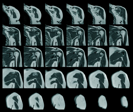 Magnetic resonance imaging of left shoulder rotator cuff tear with suspected lipoma of left shoulder science and education mri shoulder background
