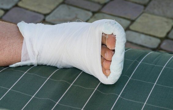 Broken leg in white plaster cast rests on a green checkered pillow. Close-up man leg with fingers. Fracture of leg after falling off the steps. The leg turned up and broke