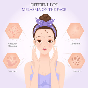 Different type melasma on the face