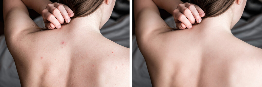 Before and after treatment acne pimples on skin back of teenager.