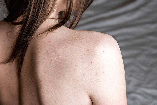 Problem skin. Young woman's back with acne, pimples and red spots.