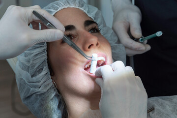 Mujer joven abre su boca y su odontólogo le coloca un rollo de algondon con una pinza odontológica - obrazy, fototapety, plakaty