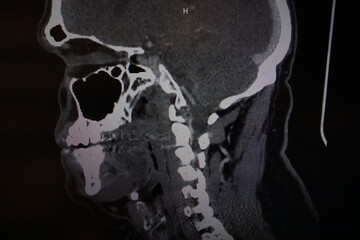 Human skull and neck, MRI image