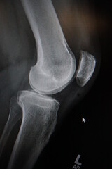 Knee cap and joint under an X-ray 