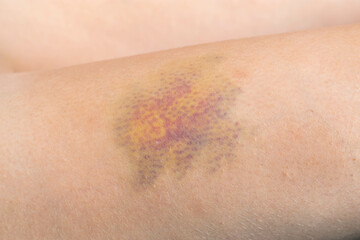 Hematoma on the leg. Large hematoma, close-up shot.