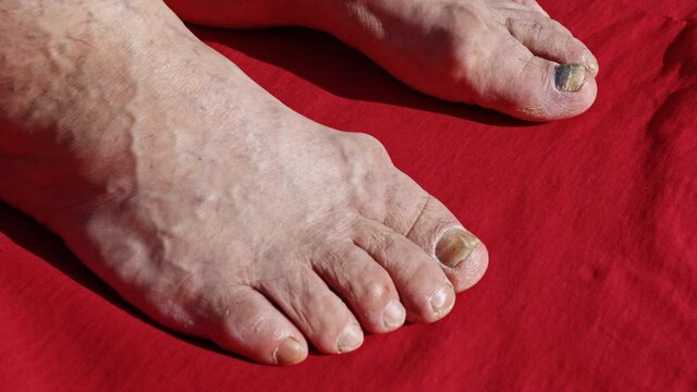 Feet of old man on red surface. Elderly person legs diseases, problems, fungus, varicose veins, pain, discomfort. Mutilated crippled nails. Dermatology, phlebology, podiatry, chiropody, pedicure