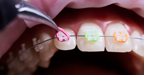 Close up of doctor installing colorful elastic rubber bands to patient brackets. Person with wired braces on teeth having dental procedure in clinic. Concept of dentistry and orthodontic treatment.