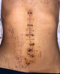 Laparotomy or midline incision at the abdomen. - obrazy, fototapety, plakaty