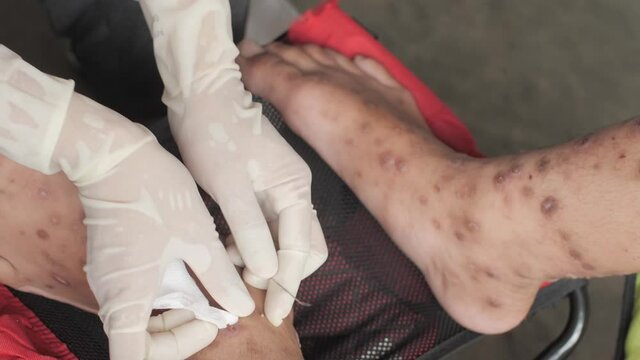 Nurse hand cleaning patient foot with ulcer filled with pus condition caused of scabies infection, sensitive skin itchy health problem