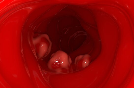 Large tumors on the colon wall in colorectal cancer 3d illustration