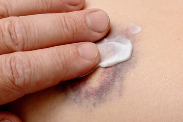 Applying ointment on the hematoma. Hematoma treatment