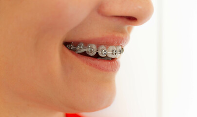  Woman with braces on teeth with elastics. Smiling face with braces isolated on white background. Orthodontic treatment. Closeup of healthy female mouth with metal braces.