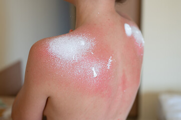 Protective aerosol is applied to sunburn on woman's back. Woman's back skin hurt from sun burn. 