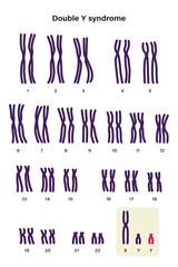 Human karyotype of Double y syndrome. XYY. Male has an extra Y chromosome.