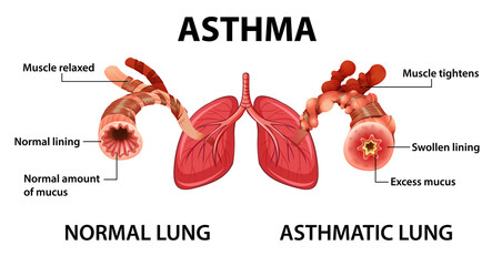 Asthma diagram with normal lung and asthmatic lung - obrazy, fototapety, plakaty