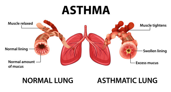 Asthma diagram with normal lung and asthmatic lung