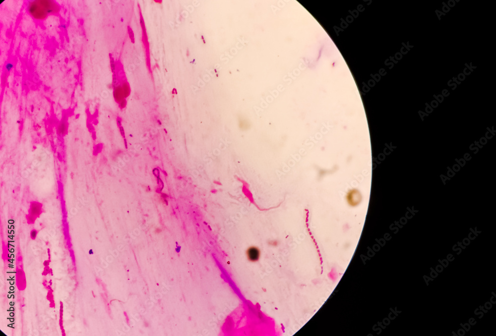 Canvas Prints Grams stain microscopic focus, Streptococci are chains of cocci, gram-positive cocci are present