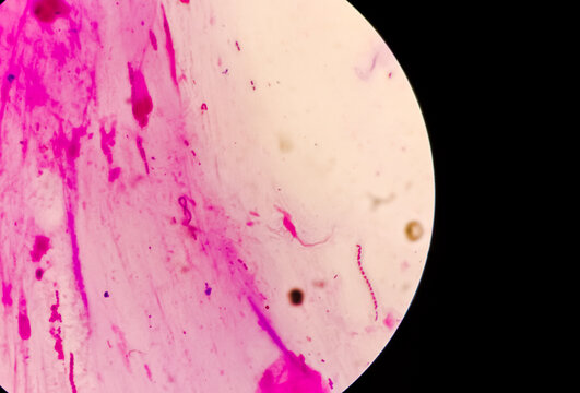 Grams stain microscopic focus, Streptococci are chains of cocci, gram-positive cocci are present
