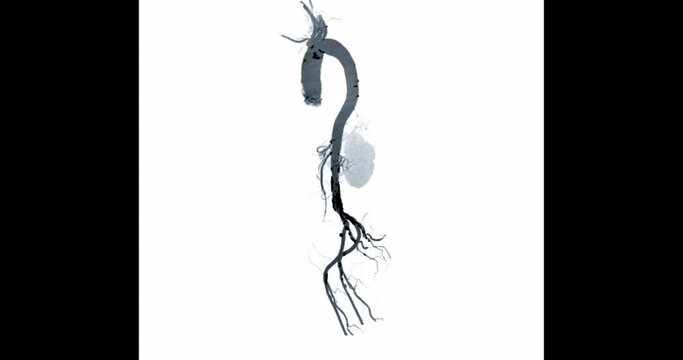  CTA whole aorta angiography filter view turn around  the screen for diagnosis aortic aneurysm.